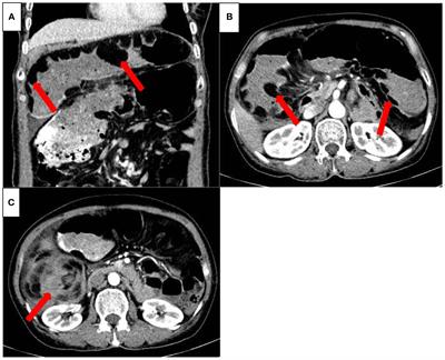 A case report of small intestinal volvulus caused by lipomatosis of the small intestine successfully treated with enterectomy